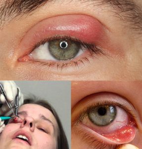 chalazion