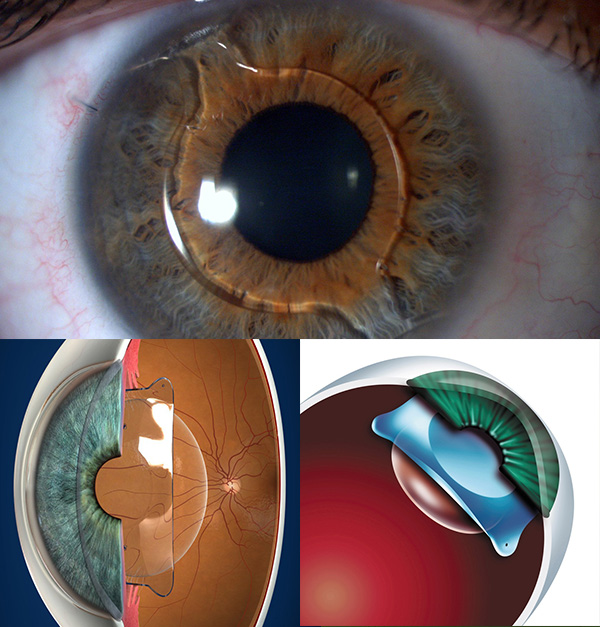 implante-de-lente-intraocular