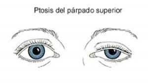 ptosis